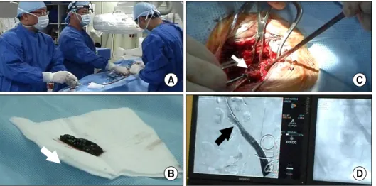 Fig. 2. (A) All surgical and inter- inter-ventional procedure were performed  in the angioroom under local  anes-thesia