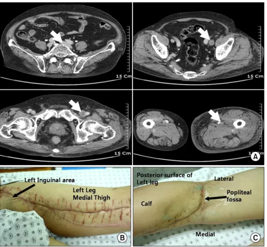 Fig. 3. Computed tomographic find- find-ings of the second case (A). Note  extensive venous thrombus and left  lower limb edema