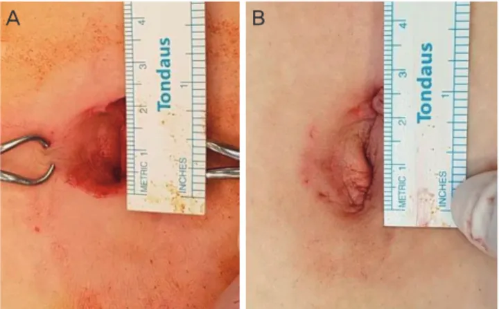 Fig. 1. Umbilicus wound (A) before starting laparoscopy, (B) after  the end of operation.