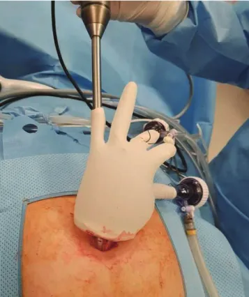 Fig. 3. Tissue extraction through umbilicus.