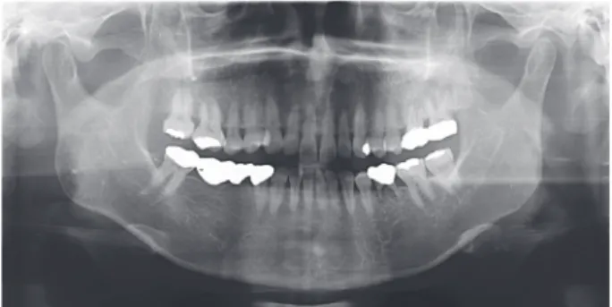 Fig. 2. Radiograph showing severe secondary  decay after old bridge removal.