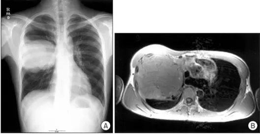 Fig. 2. A: En-bloc resection of  chest wall. The mass seems to  involve right upper lobe and right  middle lobe