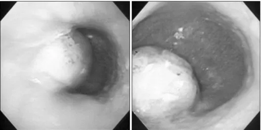 Fig. 1. The pre-operative esopha- esopha-goscophy found the about 5×6  cm sized oval shape-submucosal  like mass at about 35 cm from  upper incisor.