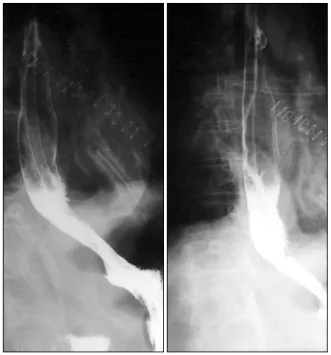 Fig. 4. The microscopic finding show whorling and palisading  patterns with spindle cell and epithelioid histology