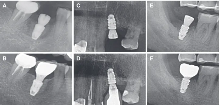 Fig. 2. Radiographic evaluation of marginal bone level change of implants which placed in ARP site (Increased MBL  after loading)