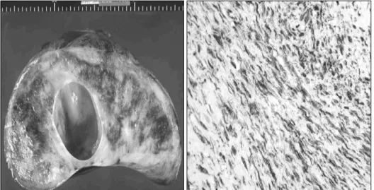 Fig. 3. Cross section of mass re- re-vealed cystic formation (left) and  positive vimentin staining on  microscopic examination (×250,  right).