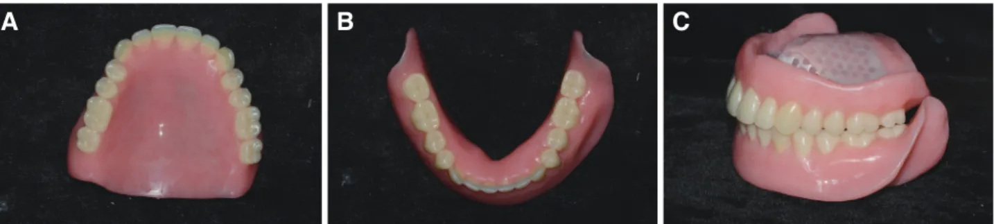 Fig. 7. Polished surface of new denture. (A) Maxillary occlusal view, (B) Mandibular occlusal view, (C) Lateral view
