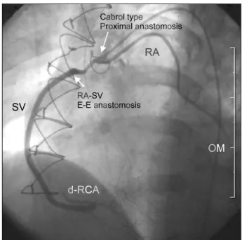 Fig. 1. Schematic view of operative technique. LITA=Left  internal thoracic artery; RA=Radial artery; SV=Saphenous vein; 