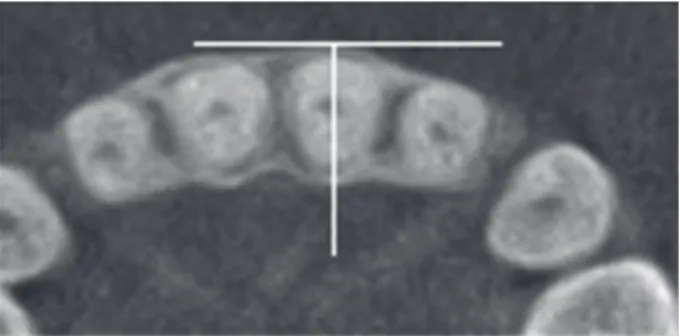 Fig. 1. Slice location in the center of the respective root,  perpendicular to the alveolar ridge.