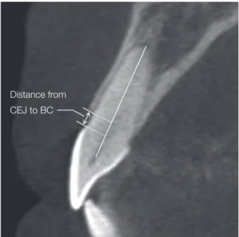 Fig. 3. Labial plate thickness at 4, 6, 8 mm from the  cementoenamel junction (CEJ).