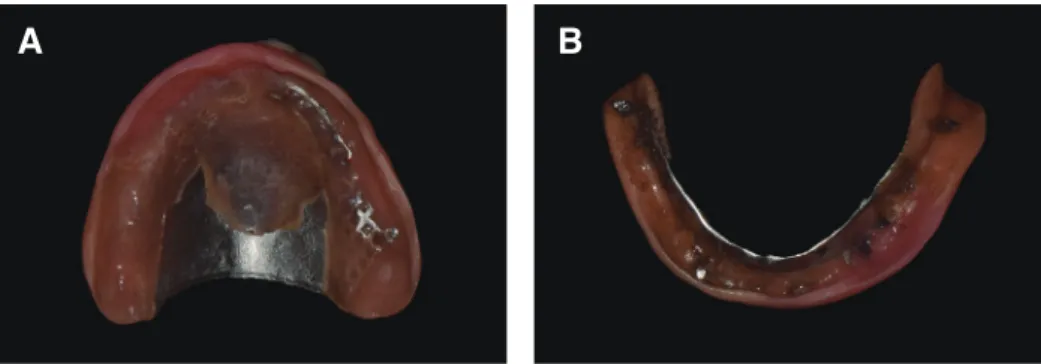 Fig. 2. Pre-existing old dentures. (A) Maxillary denture with partial dislodgement of a relining material, (B) Mandibular  denture with the short posterior border.