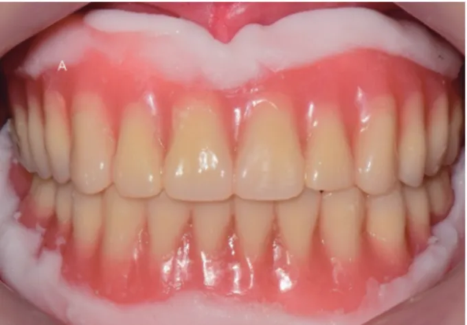 Fig. 6. Maxillary impression. (A) Border molding using modeling compound, (B) Impression, (C) Master cast, (D) Win- Win-dow formation on flabby ridge.