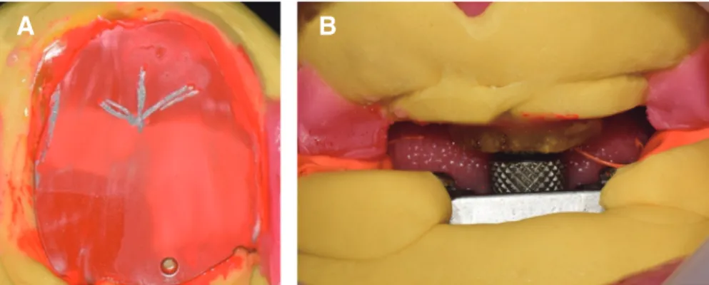 Fig. 8. Bite registration using alu-wax for clinical remounting (A), and lingualized occlusion (B, C).