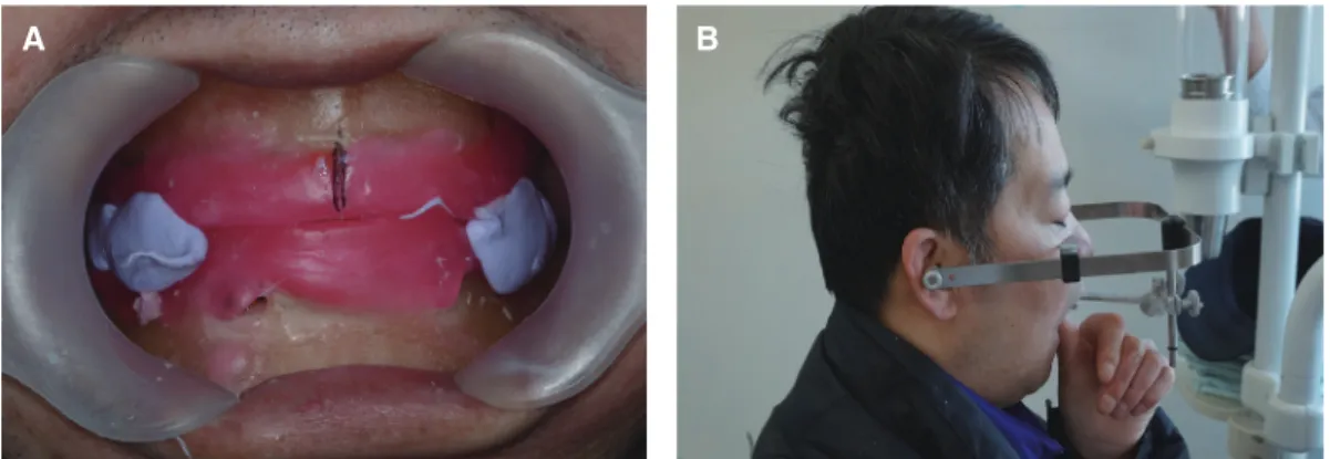 Fig. 7. Wax denture try-in.