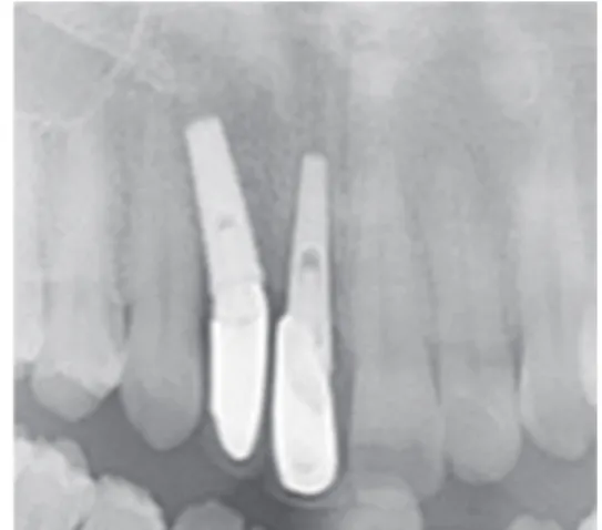 Fig. 2. Initial radiograph showing that the alveolar bone  around implants was resorbed and the paths of the two  implants were poor
