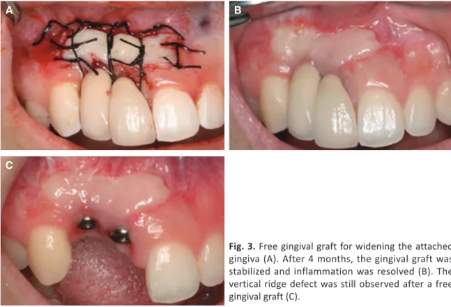 Fig. 3. Free gingival graft for widening the attached  gingiva (A). After 4 months, the gingival graft was  stabilized and inflammation was resolved (B)