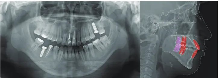 Fig. 9. Post-treatment panoramic and lateral cephalometric radiographs of Case II.