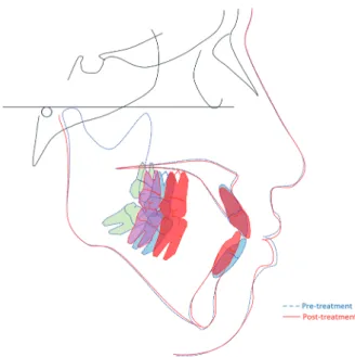 Table 4. Case II patient’s pre- and post-treatment cepha- cepha-lometric analysis. It shows dental change of  both incisors  but skeletal pattern was not changed significantly