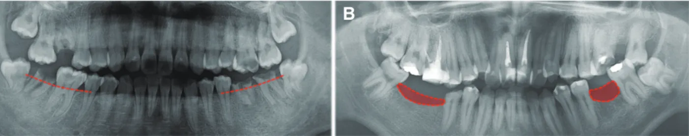 Fig. 11. Comparison of (A) case I and (B) case II patient’s pre-treatment alveolar bone level