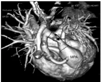 Fig. 1. 3-dimensional CT shows double aortic arch which has  dominant right arch (R). Left arch (L) has an atretic segment (*)  between left subclavian artery and descending thoracic aorta