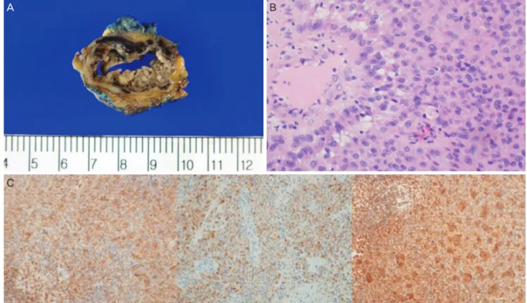 Fig. 1. Gross, histopathological, and immunohistochemical findings. (A) Shown is the gross finding of a mass of 3×2 cm in size in the skin  over the right lower labia, which is suggestive of Bartholin’s cyst in the right labium