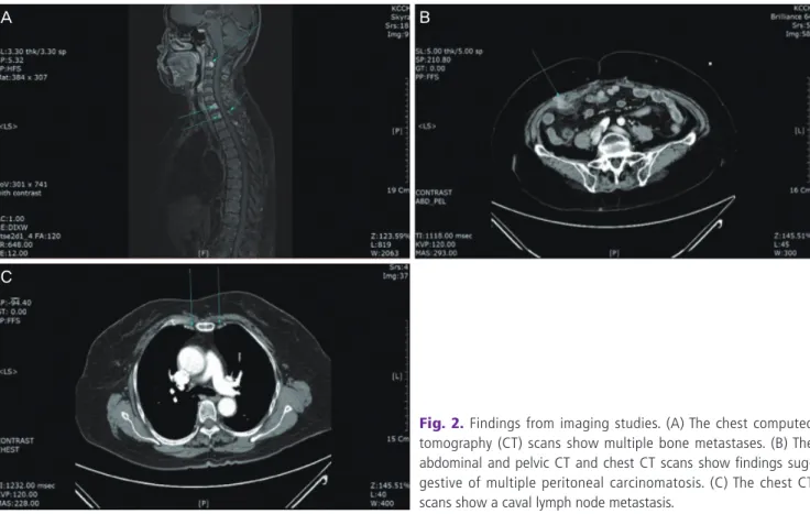 Fig. 2. Findings from imaging studies. (A) The chest computed  tomography (CT) scans show multiple bone metastases