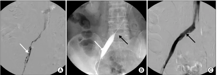 Fig. 2. Intraoperative venogram of a 72 year old woman. (A) Shows complete occlusion of left common iliac vein by thrombus (white ar- ar-row)