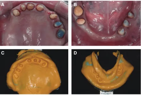 Fig. 4. Teeth preparation and final impression. (A) Maxillary teeth, (B) Mandibular teeth, (C) Final impression of Maxilla,  (D) Final impression of Mandible.