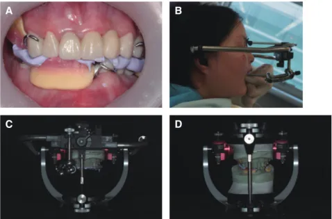 Fig. 8. (A) Maxillomandibular relationship registration, (B) Facebow transfer, (C, D) Mounting procedure to semi- semi-adjustable articulator.