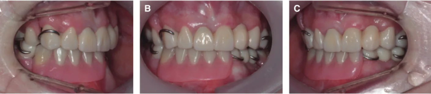 Fig. 10. Definitive denture. (A) Lateral view (right), (B) Frontal view, (C) Lateral view (left).