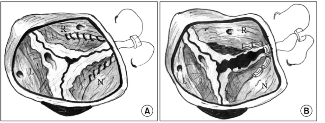 Fig. 1. (A) Diagrammatic portrayal  of the valvuloplasty using continuous  suture in case 1
