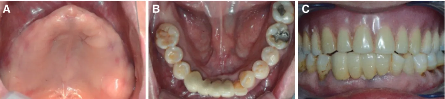 Fig. 2. Presurgical prosthetic planning. (A) Surgical margin on the study cast, (B) Centric relation record registration.