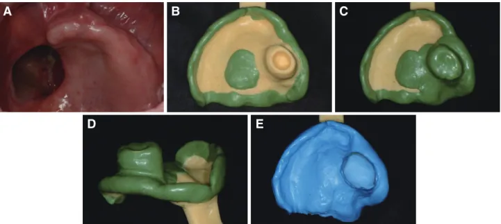 Fig. 5. Definitive obturation phase. (A) Maxillary occlusal view 16 weeks after maxillectomy, (B, C) Border molding of  the definitive obturator, (D) Scar band presented on border molding compound wax, (E) Final impression completed  with polyvinyl siloxan