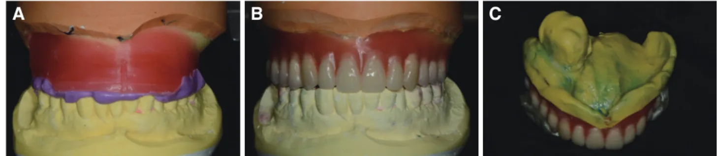Fig. 6. (A) Mounting of the master cast, (B) Wax obturator, (C) Wash impression completed with light-body polyvinylsiloxane.