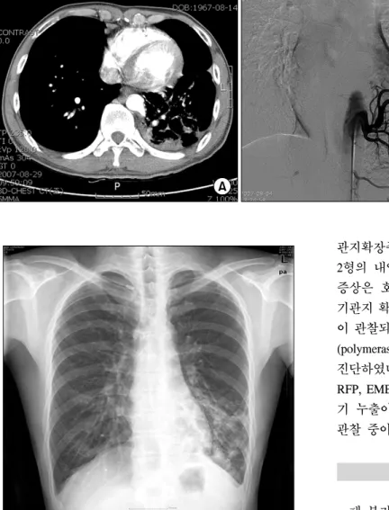 Fig. 2. (A) Chest CT shows the  origin of a large feeding artery  and irregular consolidation in left  lower lobe