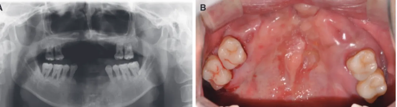 Fig. 1. (A) Initial panoramic radiograph, (B) Initial intraoral photograph, Maxillary occlusal view.