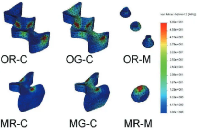 Fig. 8. Von Mises stress distribution by occlusal loading  in the abutment tooth with M-D cross-sectional view