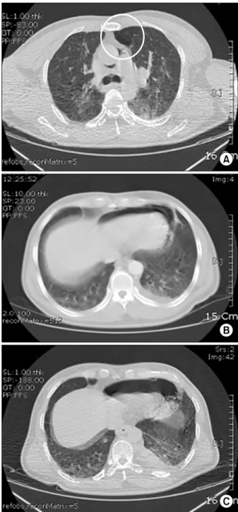 Fig. 2. (A) Initial chest CT shows minimal pneumothorax on left  hemithorax (in the white circle)