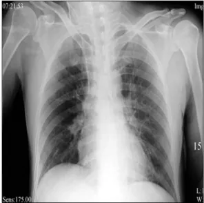 Fig. 4. Simple chest X-ray after removal of chest tubes.