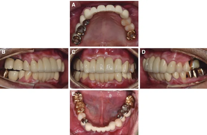 Fig. 9. Panoramic radiograph after placement of the de- de-finitive prostheses. 