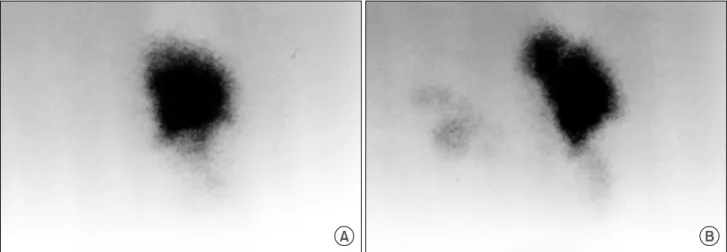 Fig. 1. Lung  perfusion scan: preoperative  (A) and 14 days after the operation  (B).