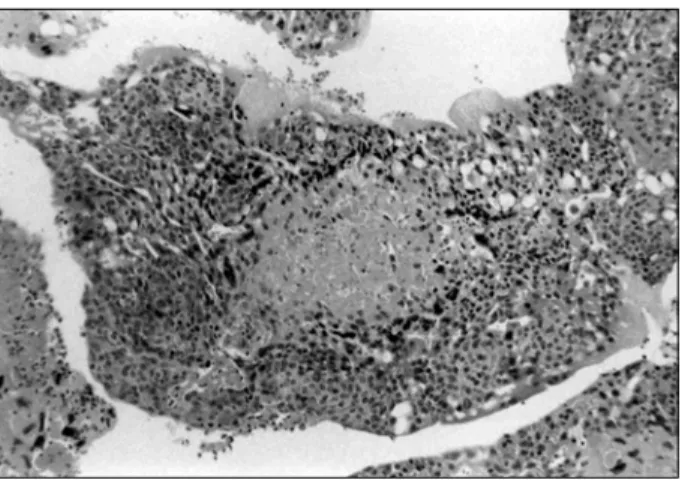 Fig. 4. The tumor is characterized by biphasic pattern which  consists of cytotrophoblasts and syncytiotrophoblasts (H &amp; E, 