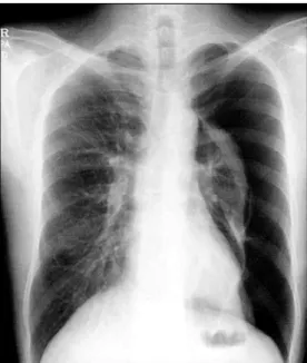 Fig. 1. Preoperative chest X-ray show pneumothorax in left  hemithorax.