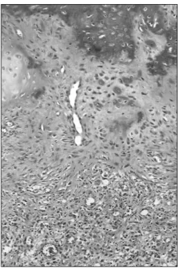 Fig. 1. Chest PA shows osteolytic lesion (white arrow) in the  right 10th rib and resected 8th rib (black arrow).