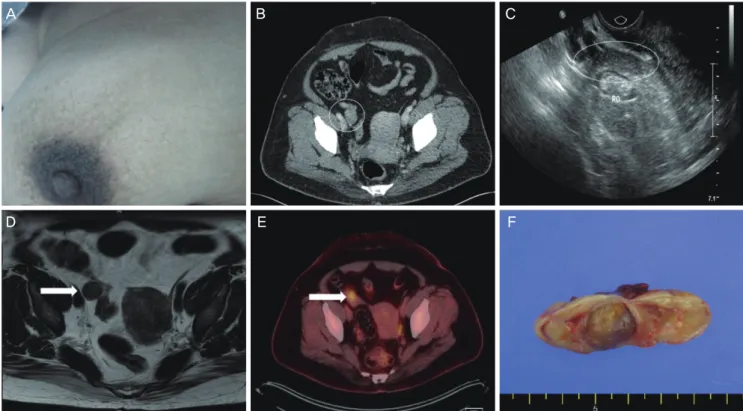 Fig. 1. (A) Truncal hirsutism: male pattern hair distribution on the patient’s chest. (B) Lopromide contrast-enhanced abdominopelvic CT: 