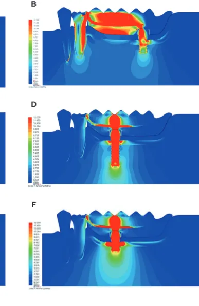 Fig. 2. von-Mises stress distribution of each model. (A)  Model A, (B) Model B, (C) Model C, (D) Model D, (E)  Model E, (F) Model F, (G) Model G.