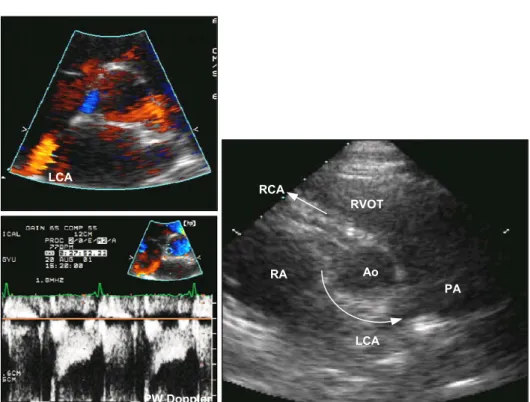 Fig. 1. Echocardiography showing anomalous origin of left coronary artery from right coronary sinus