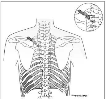 Fig. 5. Schematic drawing showing injuries inflicted upon Lee  Wan-Yong.은 외상성 늑막염에 기인한 것이다