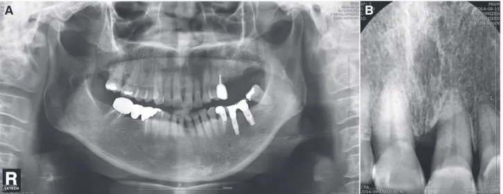 Fig. 2. Pre-treatment panoramic (A) and periapical (B) radiographs. (A) Generalized alveolar bone loss was observed