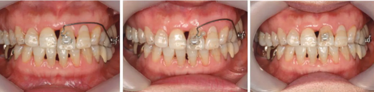 Fig. 7. Progression of orthodontic treatment (during 5 months). #21 was gradually intruded by segmental intrusion arch